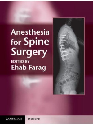 Anesthesia for Spine Surgery - Cambridge Medicine