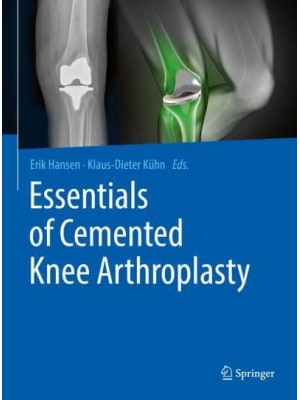 Essentials of Cemented Knee Arthroplasty