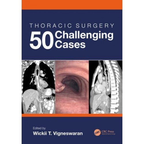 Thoracic Surgery 50 Challenging Cases