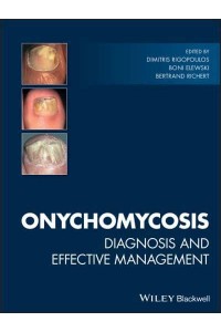 Onychomycosis Diagnosis and Effective Management