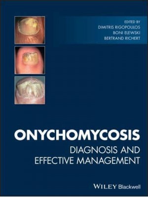 Onychomycosis Diagnosis and Effective Management