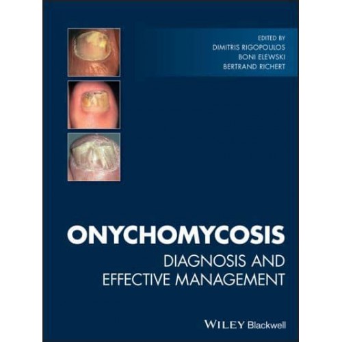 Onychomycosis Diagnosis and Effective Management