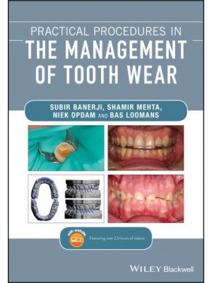 Practical Procedures in the Management of Tooth Wear