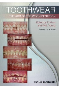 Toothwear The ABC of Worn Dentition