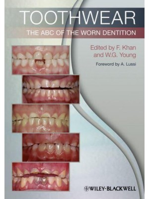 Toothwear The ABC of Worn Dentition