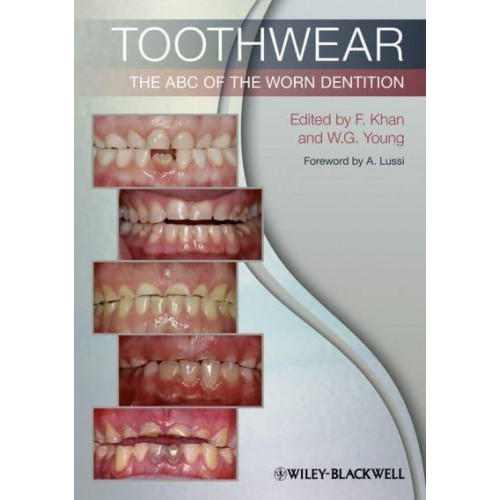 Toothwear The ABC of Worn Dentition