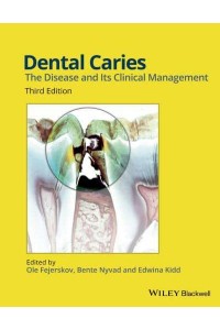 Dental Caries The Disease and Its Clinical Management