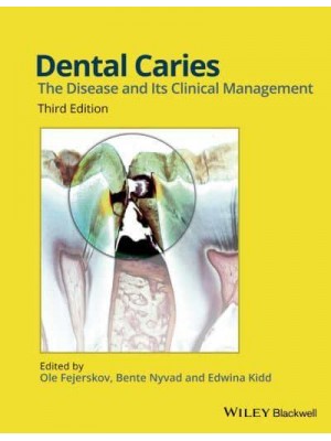 Dental Caries The Disease and Its Clinical Management