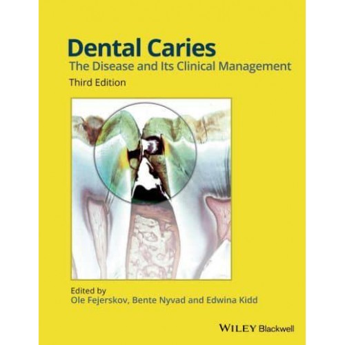 Dental Caries The Disease and Its Clinical Management