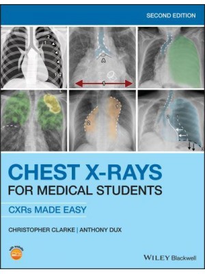 Chest X-Rays for Medical Students