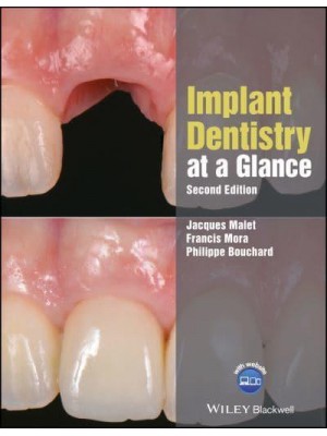 Implant Dentistry at a Glance - At a Glance (Dentistry)