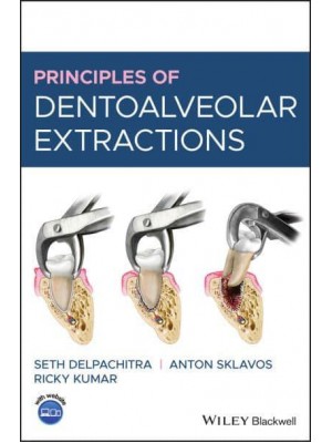 Principles of Dentoalveolar Extractions