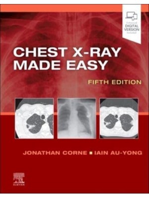 Chest X-Ray Made Easy - Made Easy