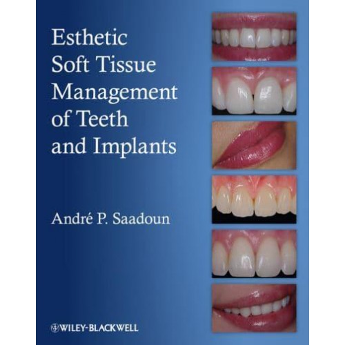 Esthetic Soft Tissue Management of Teeth and Implants