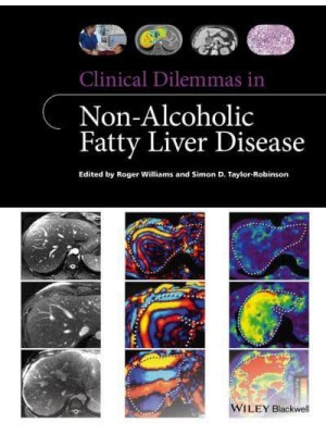 Clinical Dilemmas in Non-Alcoholic Fatty Liver Disease - Clinical Dilemmas (UK)