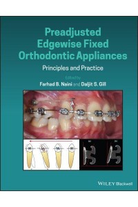 Preadjusted Edgewise Fixed Orthodontic Appliances Principles and Practice